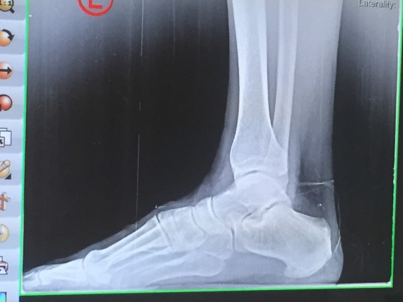 Foot x-ray